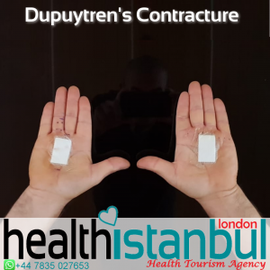 Dupuytren’s Contracture  